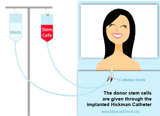 Stem Cell Transplant